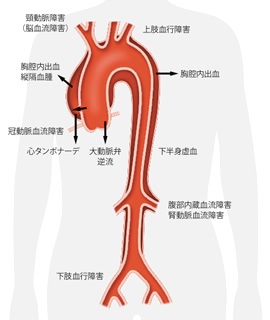 解離性大動脈瘤（大動脈解離）による併発症状