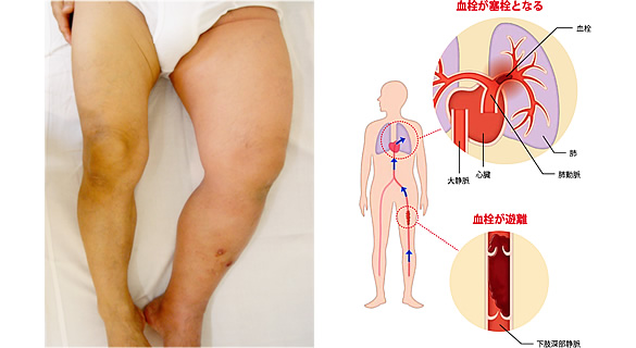 深部静脈血栓症を起こした左足