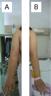 A　右上肢リンパ浮腫第2期　B　左上肢リンパ浮腫認めない