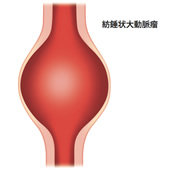 紡錘状大動脈瘤