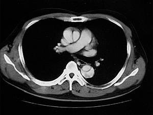 解離性大動脈瘤（大動脈解離）のCT写真